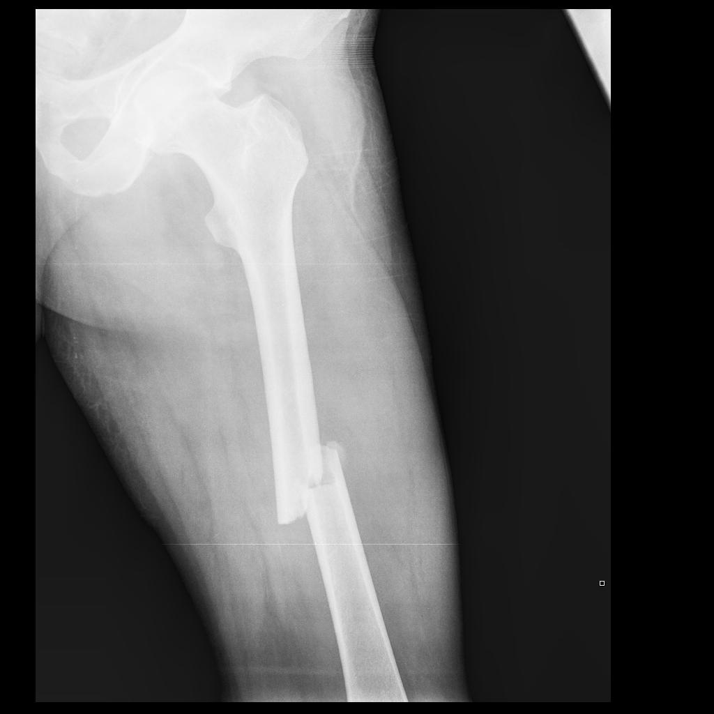 femur